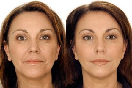 LPG Massage vum Gesiicht virun an no